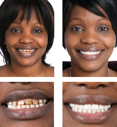 Porcelain Veneers